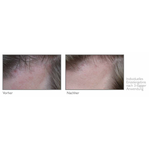 Vorher Nachher - Anwendung des Biocutin Head Treatment pure bei trockener, schuppiger Kopfhaut